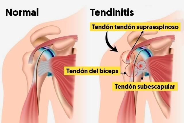 tratamiento tendinitis hombro madrid